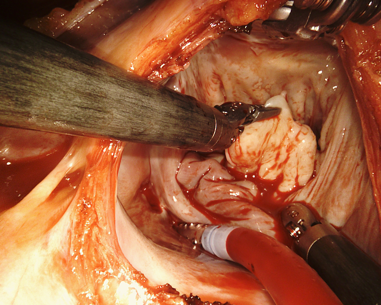Mitral valve repair for degenerative disease